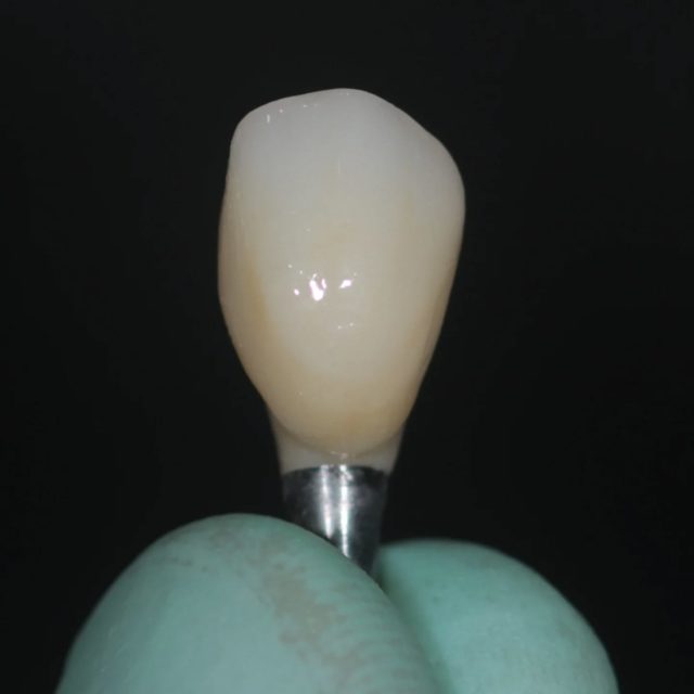 ✨️ Prótese sobre implante: precisão e naturalidade

Na imagem, você vê o resultado final de uma coroa protética pronta para ser instalada sobre um implante dentário. 🦷

Cada detalhe é pensado para devolver ao paciente estética, função e conforto — como se fosse um dente natural.

Esse é o tipo de trabalho que transforma sorrisos e devolve a confiança.

Agende sua avaliação e descubra se essa é a solução ideal para o seu caso.