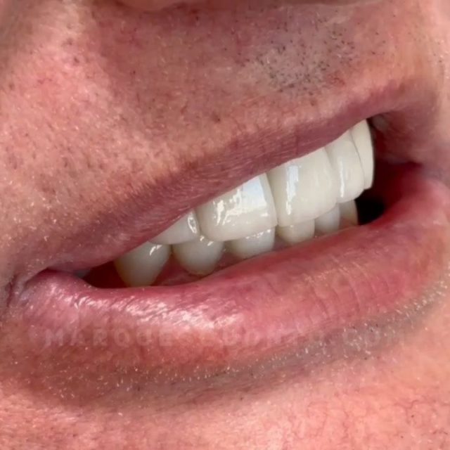 ✨ Transformação incrível com lentes e coroas de porcelana! ✨

Mais do que estética, este caso representa a devolução da confiança, da saúde bucal e da autoestima. 💪

Nosso paciente chegou até nós buscando sorrir sem medo — e com planejamento digital e técnica de excelência, reconstruímos cada detalhe do sorriso, corrigindo desgastes e alinhando os dentes de forma natural e personalizada.

O resultado? Um sorriso harmônico e verdadeiro, que reflete felicidade e faz toda a diferença no dia a dia. 😍

👉 Deslize para ver o antes e depois dessa transformação!

Os resultados impressionam, mas a alegria dos nossos pacientes nos motiva ainda mais! ♥️

📸 Publicação autorizada pelo paciente.
💉 O resultado é individual e personalizado.